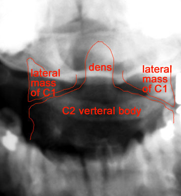 Jefferson Fracture Odontoid View jefferson-fracture-odontoid-view